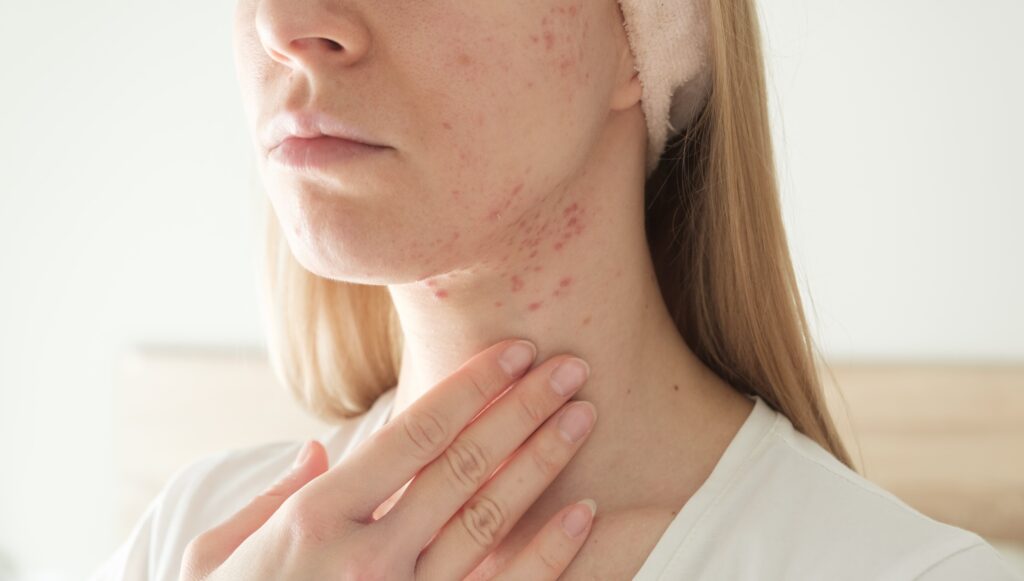 Learn about the causes of cystic pimples, and discover the best treatments for them.