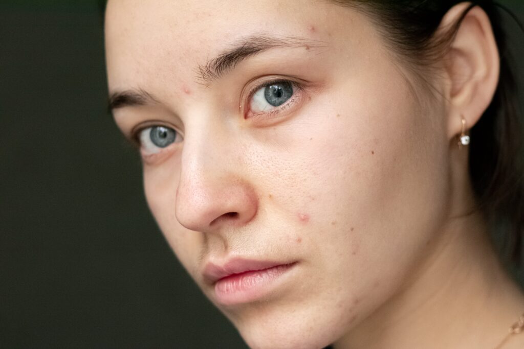 Learn how to get rid of hormonal acne in the most effective ways and find out which treatments are best for each type of acne.