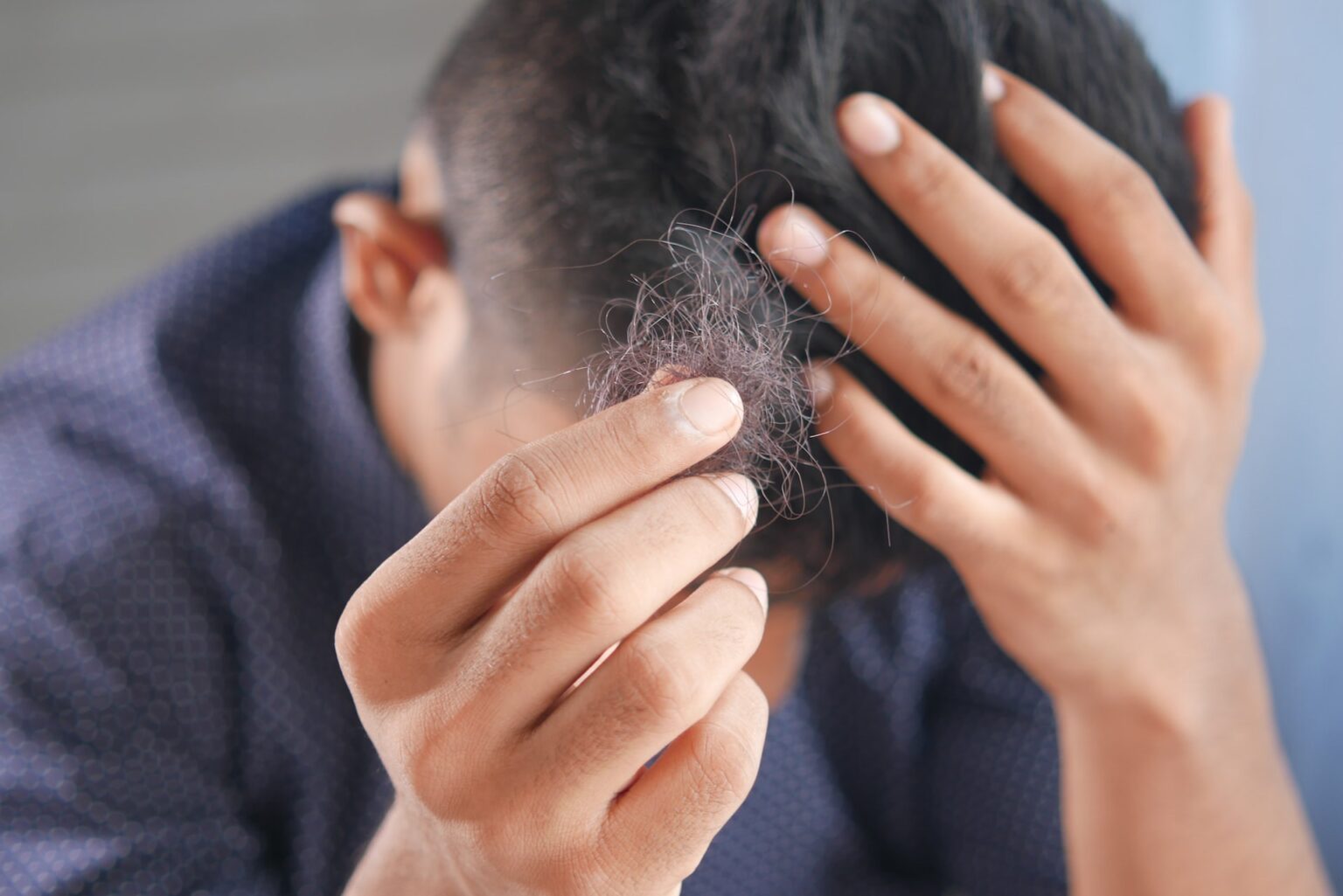 Alopecia, also known as hair loss, is a condition that affects millions of people worldwide. However, what causes it? Learn more in this article!